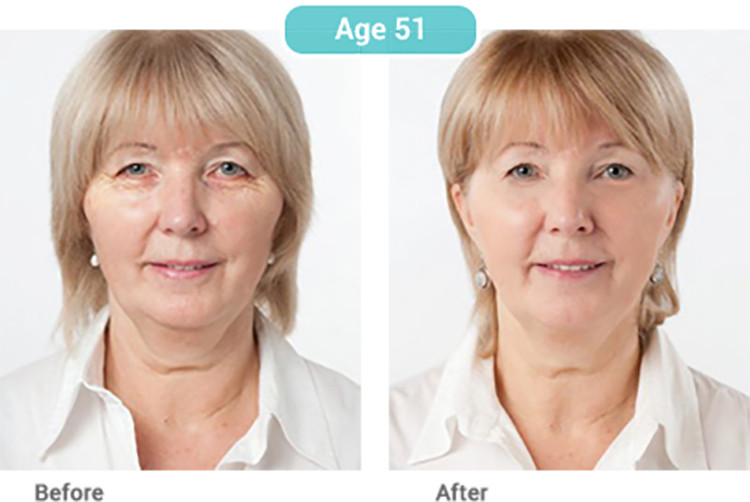 Stem Cell Serum Anti Aging Real Stem Cell Cultures Matrixyl 3000 Hyaluronic Acid