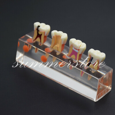 Dental 4 Stage Endodontic Root Canal Treatment Teeth Demonstrates Model 4018