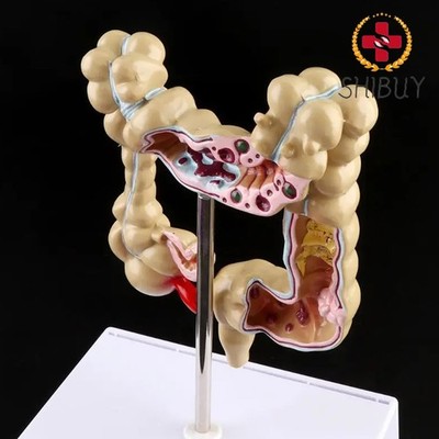 Colorectal Lesion Model Human Colon Snake Large Intestine Pathological Diseases