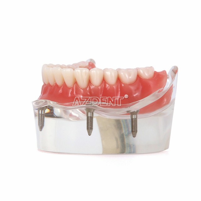 Modèle Dentaire Typodont 200 Avec Dents Amovibles - Compatible Kilgore, NISSIN M8012, Pour étudiants Et Laboratoires