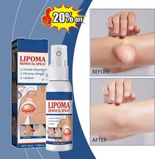 50ML Lipomheilung Reduction Spray, Instant LumpFree Lipoma Removal Spray