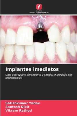 Implantes imediatos by Satishkumar Yadav (Portuguese) Paperback Book