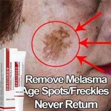 Powerful Spot-removing Whiten Cream Pigmentation Melasma Dark Spots
