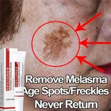 Powerful Spot-removing Whiten Cream Pigmentation Melasma Dark Spots