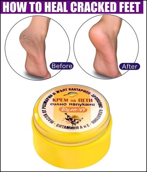 Worried about your cracked heels? Easy home remedies to treat them | Health  - Hindustan Times