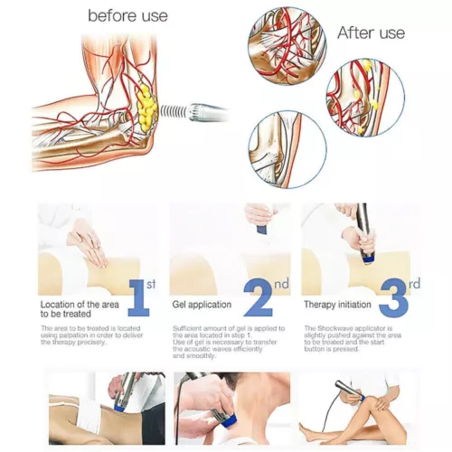 ED Shockwave Therapy Machine dispositivo de terapia de ondas de choque dispositivo de terapia de ondas de choque - Imagen 17 de 17