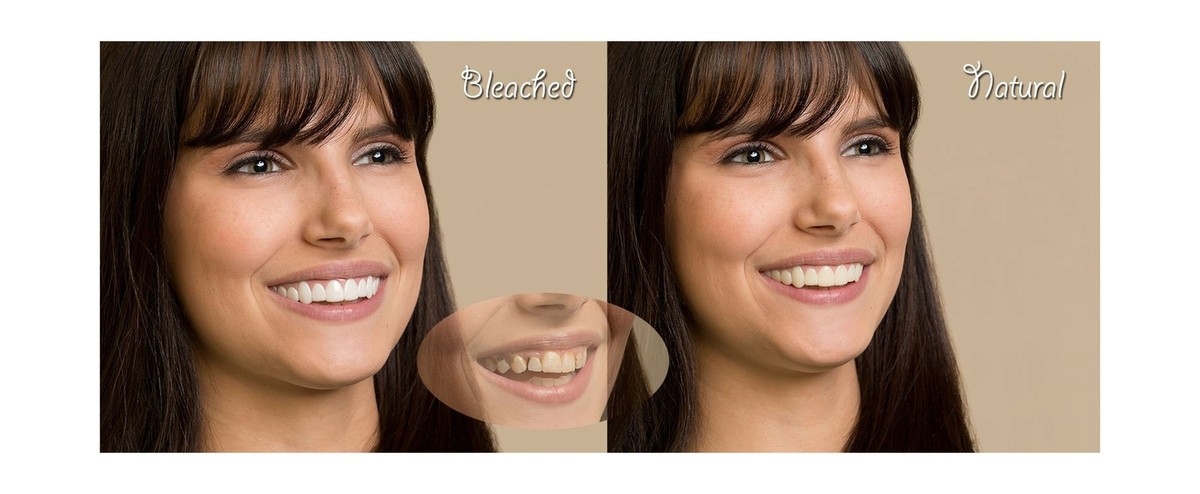 Imako Cosmetic Teeth Small Bleached Flexible Device Dental