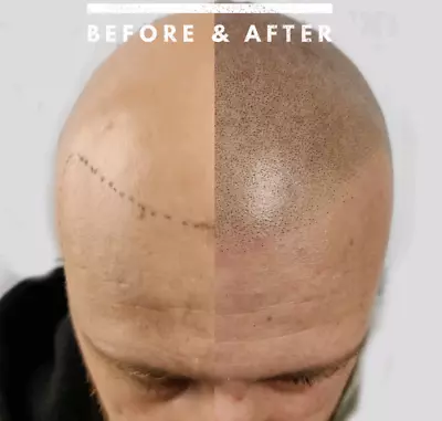 Scalp Micropigmentation Hair Tattoo