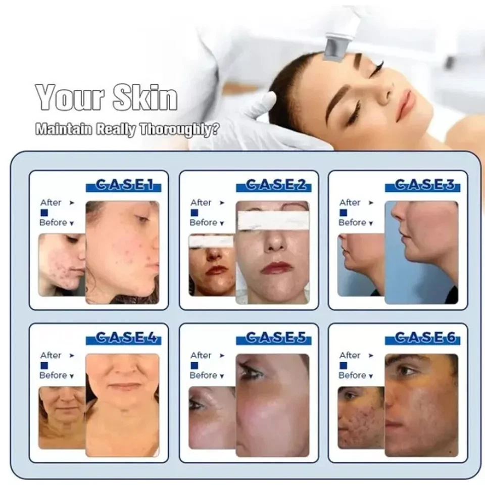 Máquina de belleza facial Hydra Spa 14 en 1 hidrodermoabrasión limpieza de la piel facial Li1y Foto 4 de 4