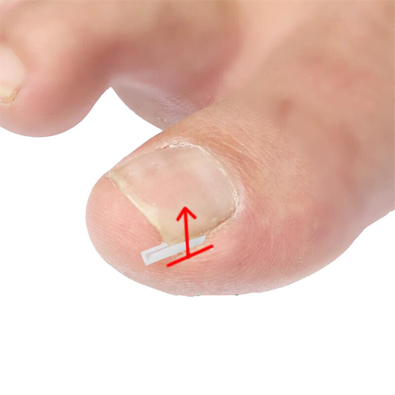 10Pcs Ingrown Toenail Corrector Toe Foot Nail Correction Sticker