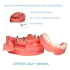 <!--F#f_0-->Dental Typodont Overdenture Restoration Model Demo Multi-unit Abutment Implant<!--F/-->
