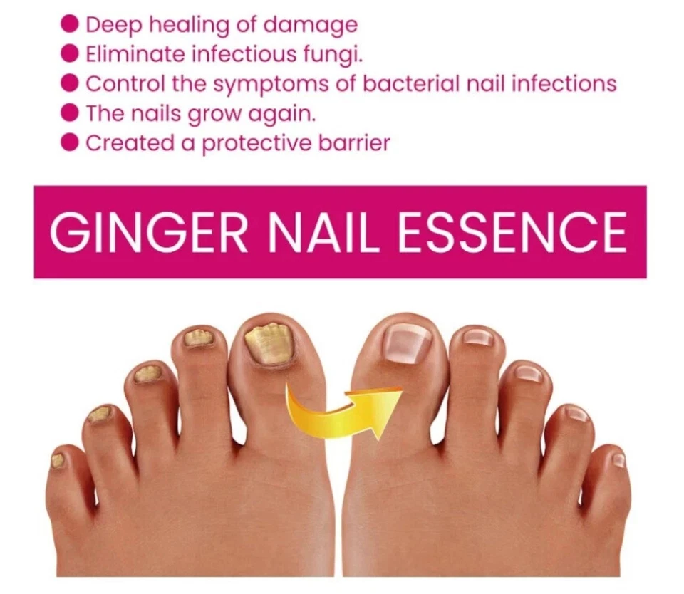 Tratamiento de uñas FungiGone de 1 ~ 5 piezas, solución para uñas de dedo del pie extra fuerte para cuidado de uñas hongos Foto 4 de 4