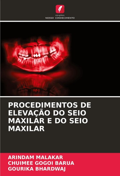 Arindam Malakar (U. A.) | Procedimentos DE ElevaÇÃO DO Seio Maxilar E DO Seio...-image