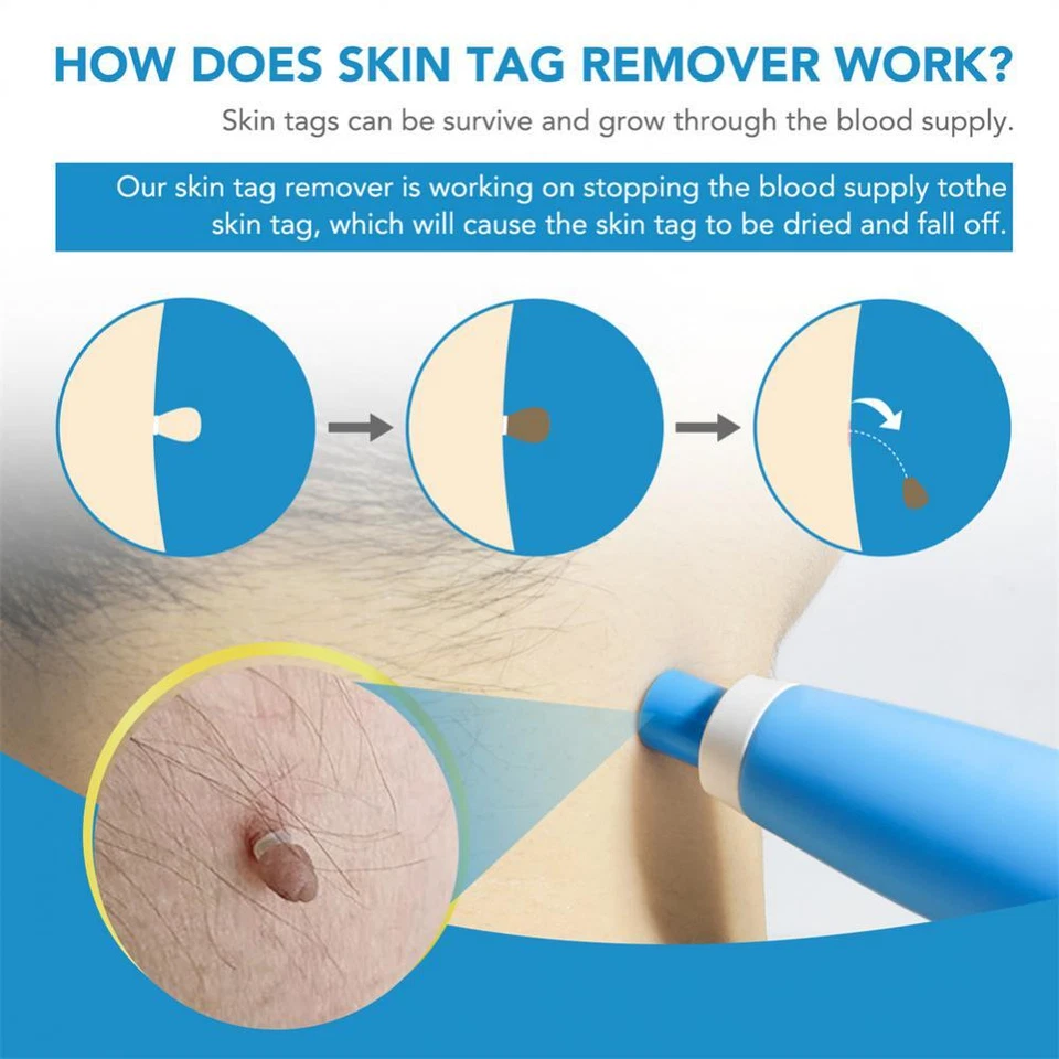 2in1 Painless Auto Skin Tag Mole Wart Removal(40x Rubber Bands +2x Alcohol Pad) - Image 3 of 4