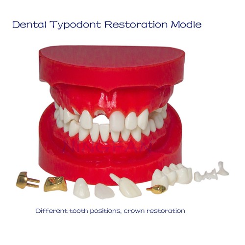 Dental Restorations Model Upper/Lower Jaw Onlay/Crown/Veneer/Bridge Removable - Picture 3 of 11