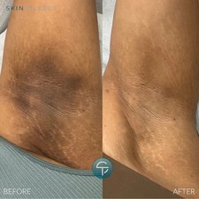 Intimate area LIGHTENING cream Dark Knees Elbows Cheeks Armpit Inner Thighs