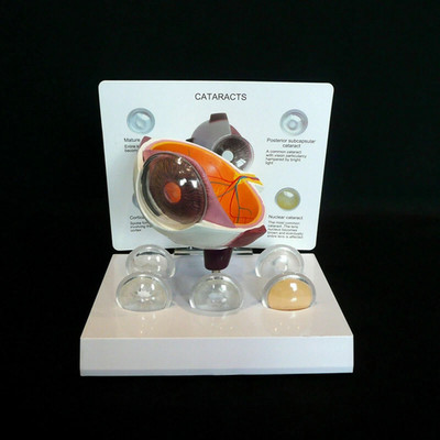 Anatomical Model of Human Cataract and Eye Disease-Medical Pathology Anatomy