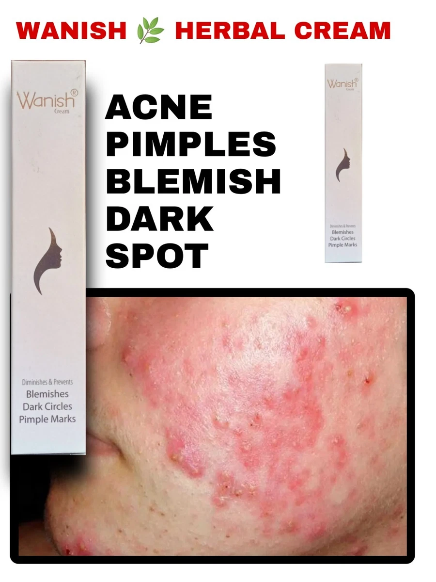 Pimple and clearance acne cream
