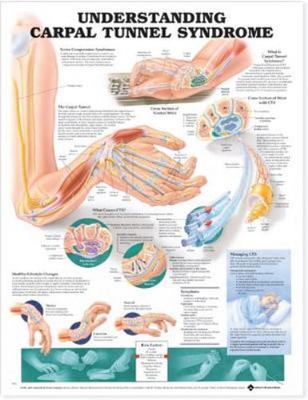 Carpal Tunnel Syndrome Chart : (laminated), Paperback by Anatomical Chart Com...
