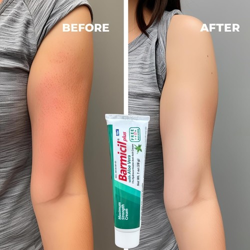 Barmicil Plus Cream w/ Aloe Vera 1% Hydrocortisone Skin Allergies, Anti Itch 1oz - Picture 5 of 9