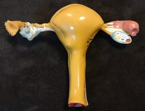 Pathological Uterus and Ovary Anatomical Model Human Female Medical Anatomy - Picture 3 of 8
