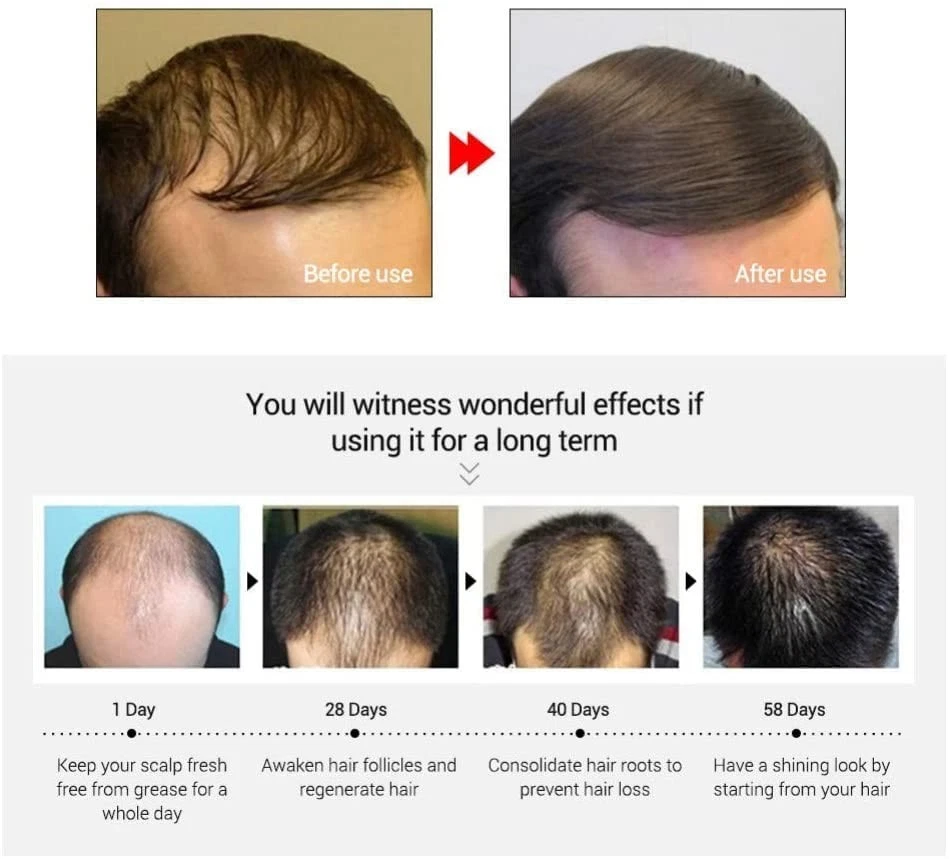 Tónico mágico para el crecimiento del cabello con ginseng - Tratamiento de pérdida de cabello 60 ml para hombres y mujeres, Foto 2 de 4