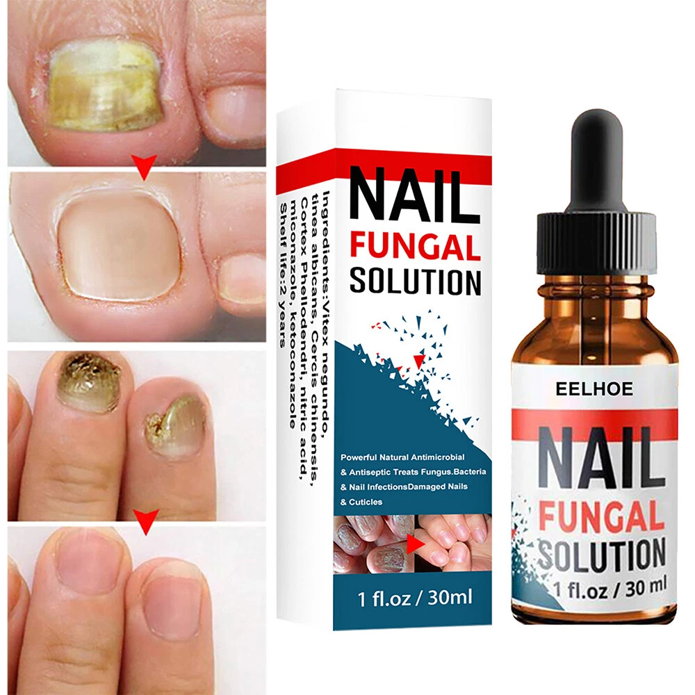 Share 146+ miconazole for nail fungus songngunhatanh.edu.vn