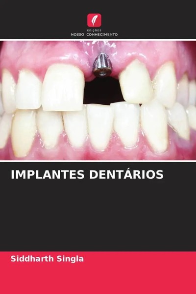 Siddharth Singla | Implantes DentÁRios | Taschenbuch | Portugiesisch (2022)-image