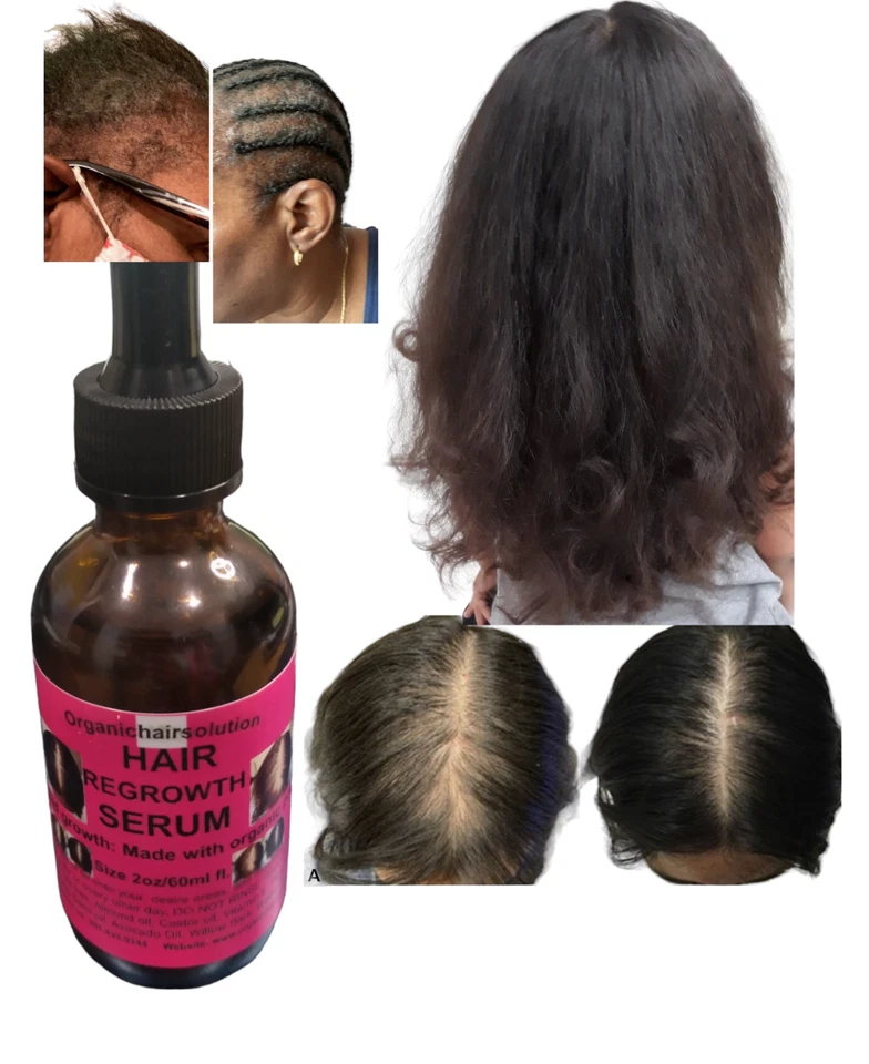 Juego de crecimiento del cabello con jojoba-castor-té árbol-cabelludo y fortalecimiento del cabello para dividir Foto 2 de 4