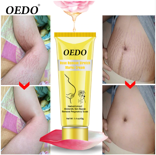 Crema Para Las Estrias Elimina Celulitis De Abdomen Senos Brazos Anti