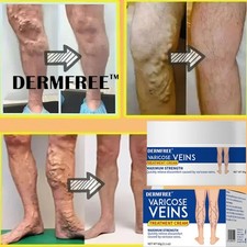 VARICOSE VEINS TREATMENT CREAM VASCULITIS PHLEBITIS SPIDER VEINS Relief Gel 60G