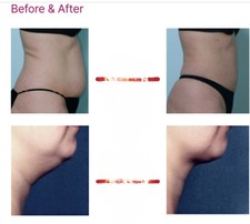 BURN Body Fat/Double Chin/Hips, Waist, Waist/Legs/Buttock LiposLab /10v