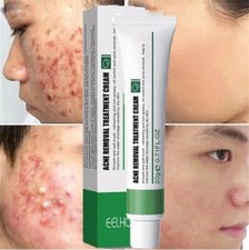 2pc Effective Acne Removal Cream Acne Treatment Skin Whitening Pimple Acne Cream
