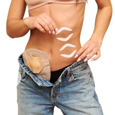 Stoma Guard Shield (Beige) for Ostomy bags | Protect your Colostomy Bags & Il...