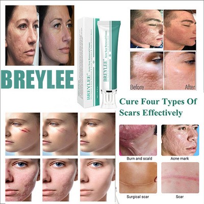 acne scar treatment cream