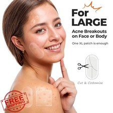 TKTK 60x30mm XL Pimple Patches Acne Hydrocolloid Bandages 265ct