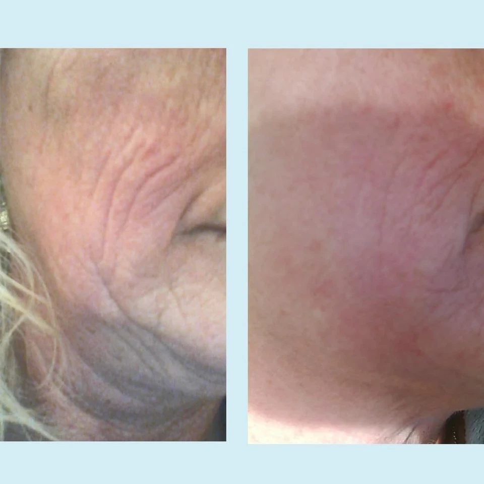 Exfoliante en gel Lactic 50 %, exfoliante químico para cicatrices de ruptura facial, exfoliante químico Foto 3 de 4