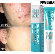 Salicylic Acid Acne Removal Cream Anti-Acne Repair Redness Pimple Oil Control