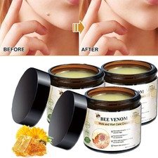 Bee Venom Skin Tag Removal Treatment Cream Body Care Mole Corn Wart Remover 60g