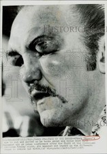 1975 Press Photo Boxer Chuck Wepner Injuries after Bout with Muhammad Ali, Ohio