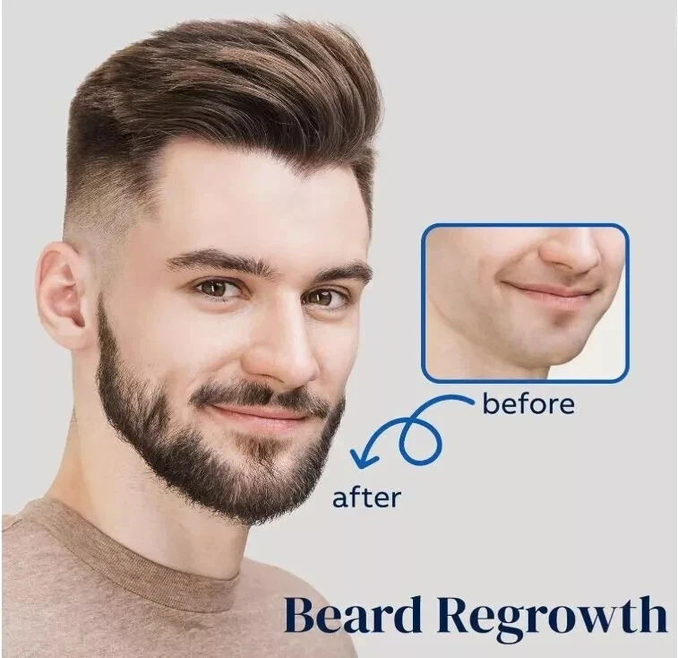 5% Minoxidil Hair Growth Spray for Men & Women - 2PCS Hair Regrowth Solution - Image 3 of 4