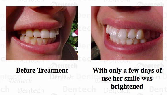16%hp LED whitening professional 2.5 gram Pen. Teeth Whitening 100 wholesale lot - Image 4 of 4