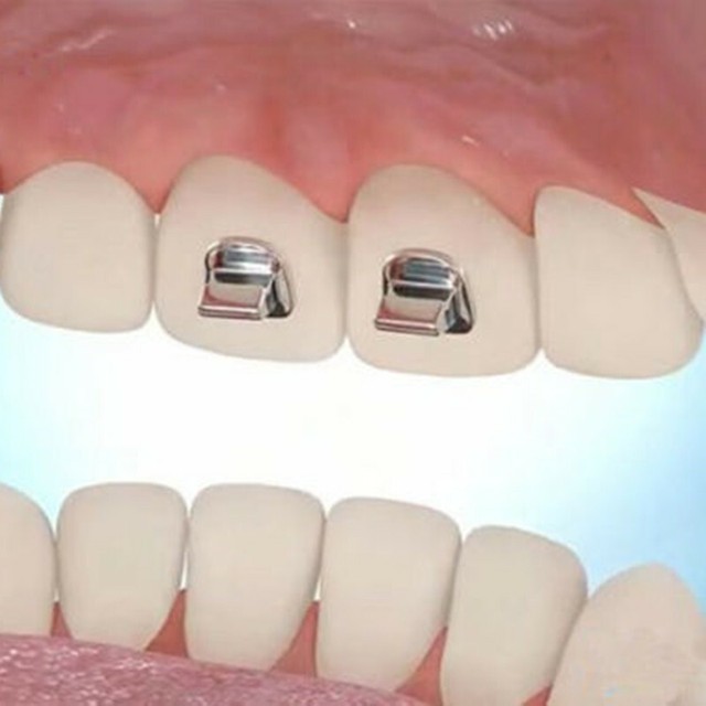 10 Kinds Dental Orthodontic Lingual Button Bondable Round Base Direct