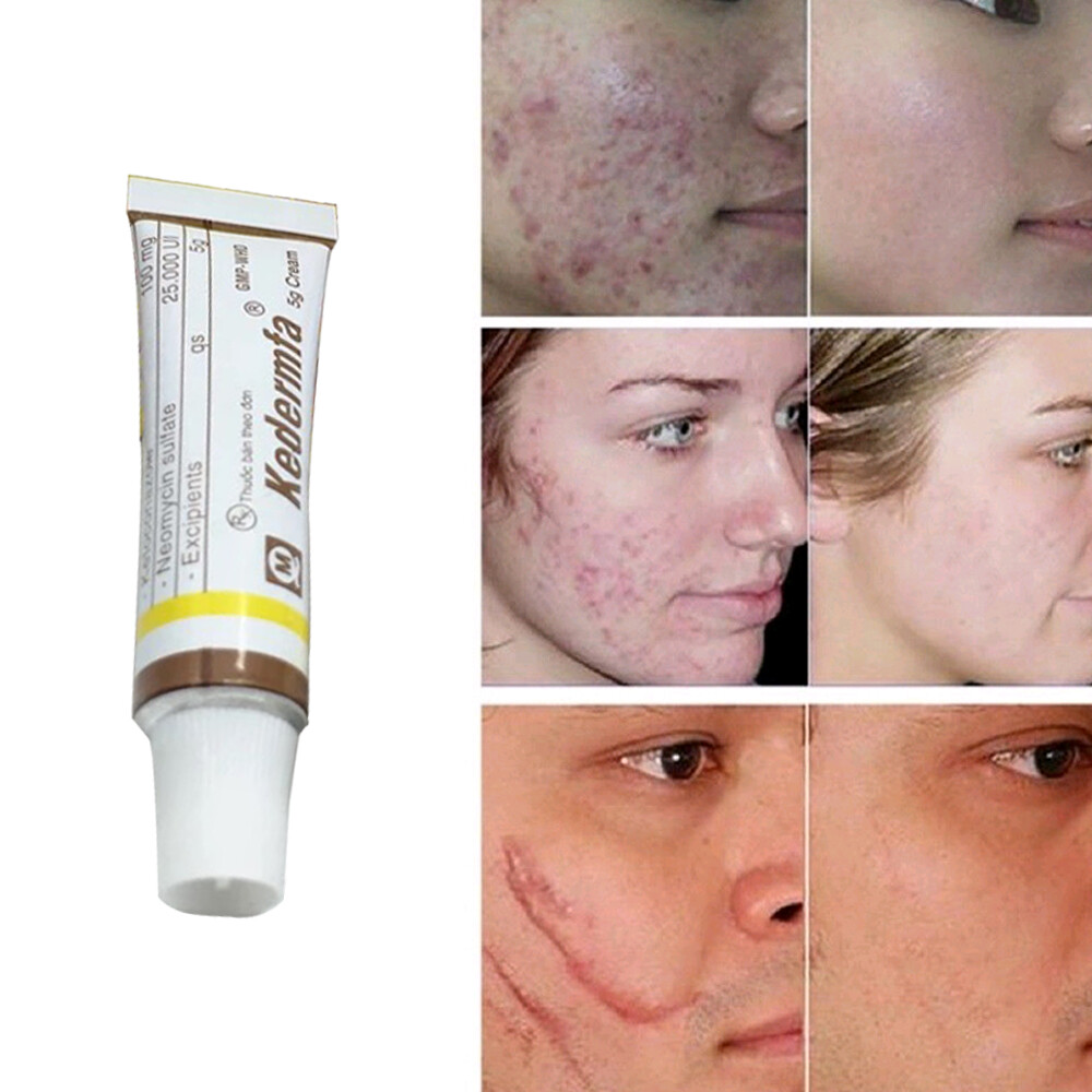 best cream for acne marks and pigmentation