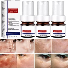 Effective Whitening Freckle Cream Remove Dark Spot Cream Removal Melanin Melasma