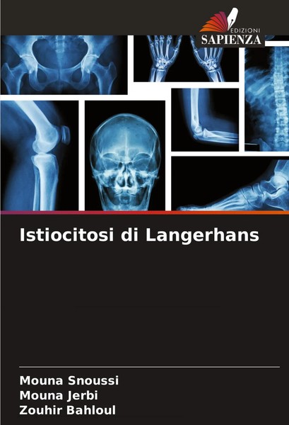Mouna Snoussi (U. A.) | Istiocitosi Di Langerhans | Taschenbuch | Italienisch-image