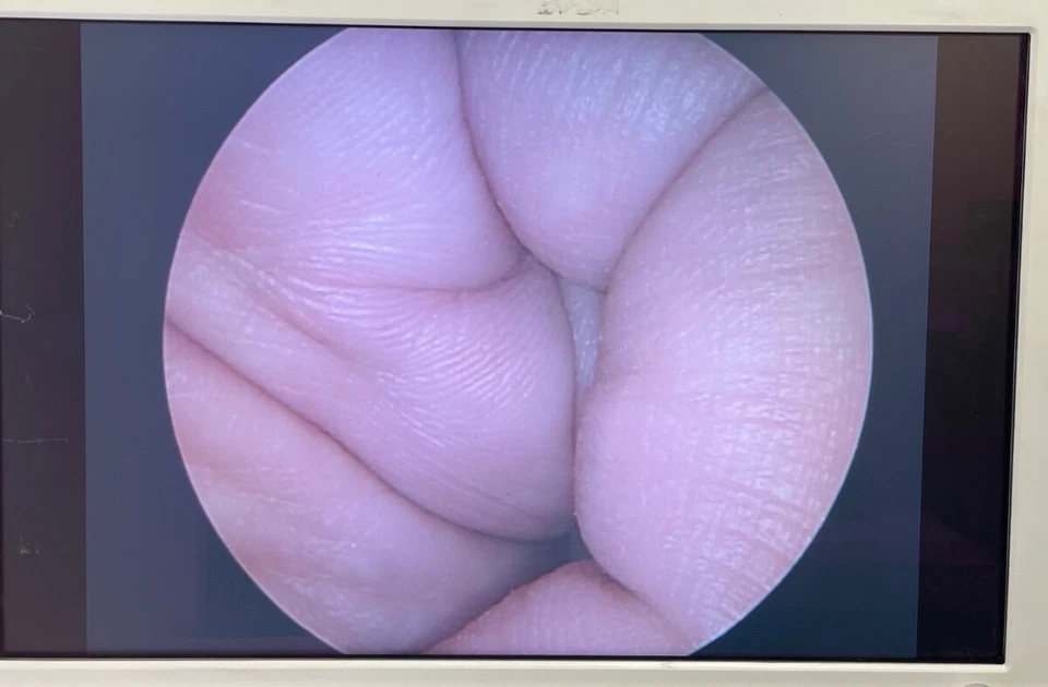 Olympus A5292A 5mm x 45° x 30cm Gold Tip Autoclavable Laparoscope Laparoscopy - Image 2 of 4