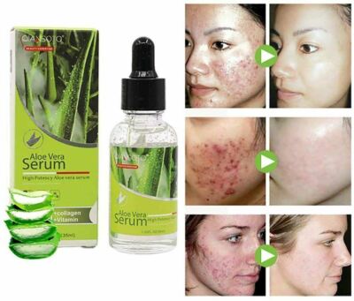 Aloe Vera Facial Serum   Natural Acne Healing & Soothing Skin Repair