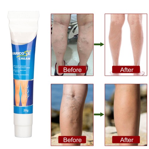 Varicose Veins Cream Strong Penetration Ingredients Gentle Leg Care Cream 20g