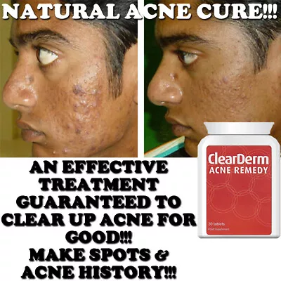 CLEARDERM ACNE PILLS TABLET STOP SPOTS REDUCE OUTBREAKS BLEMISHES CLEAR SKIN